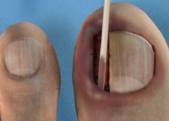 Masochist, teennagel verwijderen? Queen Jazz en Empress CatastroV!