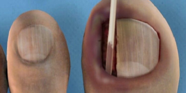 Masochist, teennagel verwijderen? Queen Jazz en Empress CatastroV!