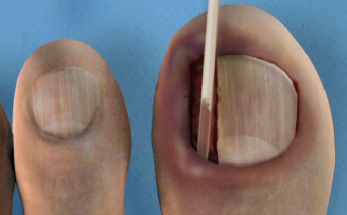 Voor de échte masochist: teennagel verwijderen, onverdoofd natuurlijk masochist: teennagel verwijderen